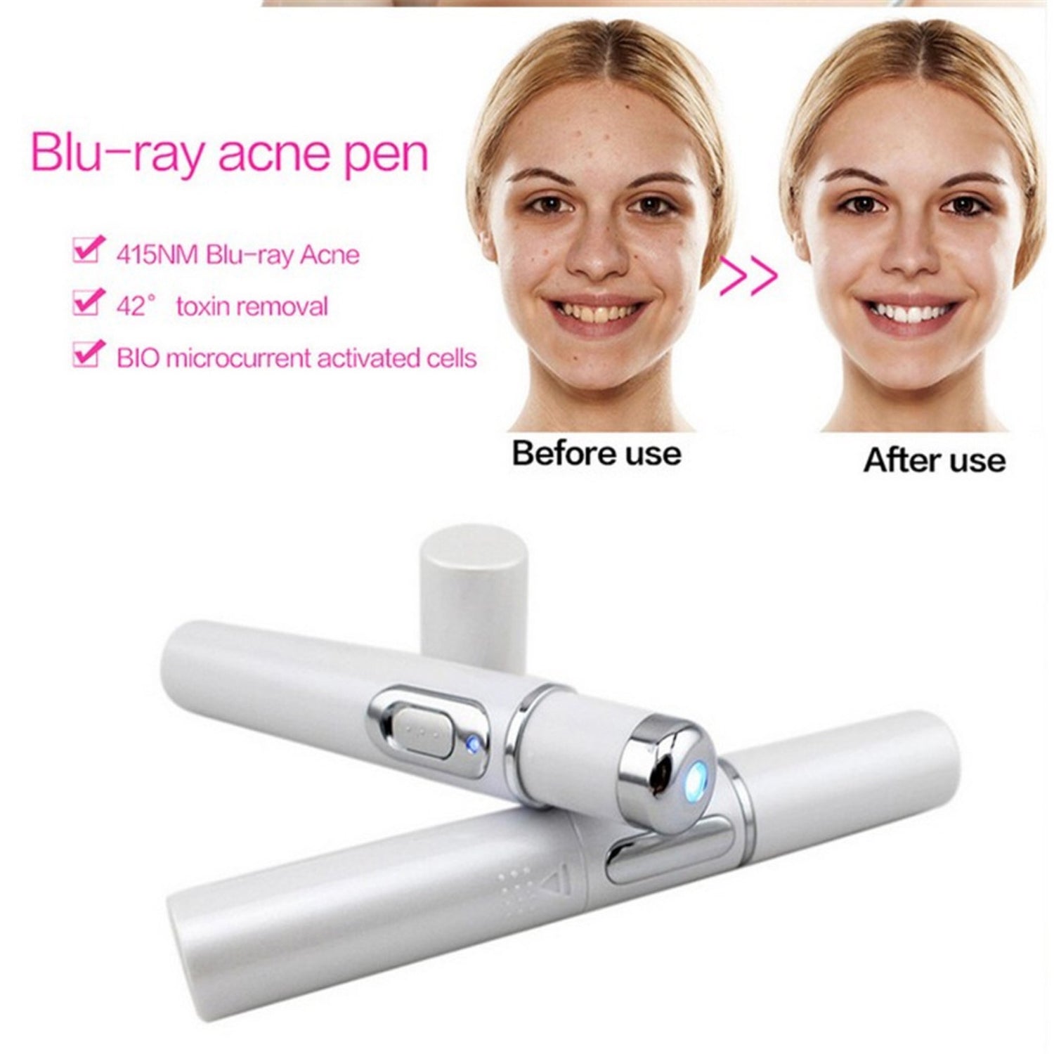 Kingdom, Blue Light Therapy Acne Laser Pen, Soft Scar Wrinkle Removal Treatment, Skin Care Beauty Technology