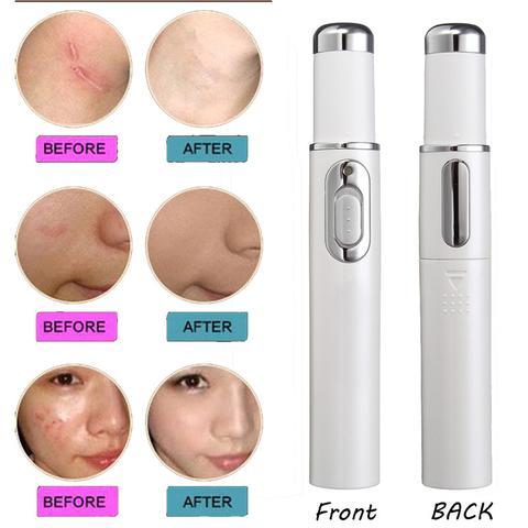 Kingdom, Blue Light Therapy Acne Laser Pen, Soft Scar Wrinkle Removal Treatment, Skin Care Beauty Technology